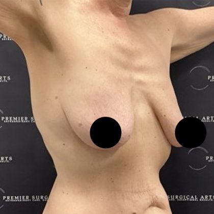 Liposuction Axilla Before & After Patient #2407