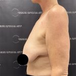 Liposuction Axilla Before & After Patient #2407