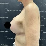 Liposuction Axilla Before & After Patient #2407