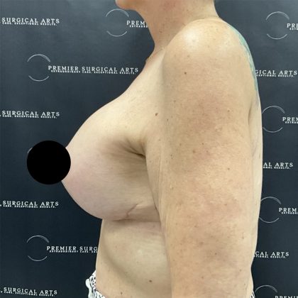 Liposuction Axilla Before & After Patient #2407