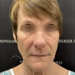 CO2 Laser Full Face and Neck Before & After Patient #2401