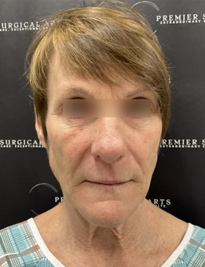 CO2 Laser Full Face and Neck Before & After Patient #2401