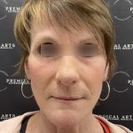 CO2 Laser Full Face and Neck Before & After Patient #2401
