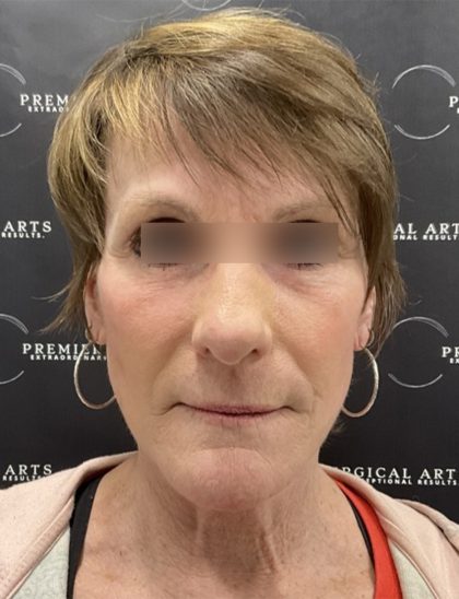 CO2 Laser Full Face and Neck Before & After Patient #2401