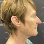 CO2 Laser Full Face and Neck Before & After Patient #2401