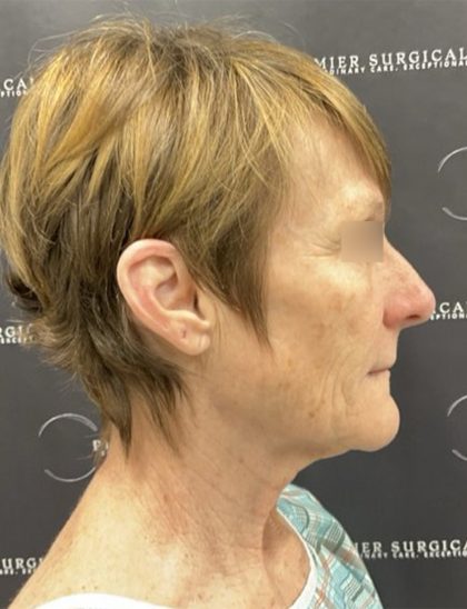 CO2 Laser Full Face and Neck Before & After Patient #2401