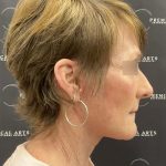 CO2 Laser Full Face and Neck Before & After Patient #2401