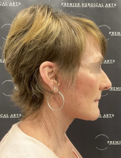 CO2 Laser Full Face and Neck Before & After Patient #2401