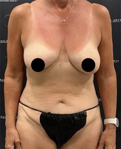 Liposuction Before & After Patient #2385