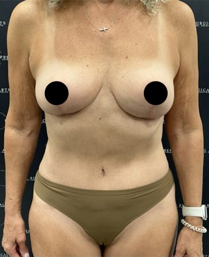 Liposuction Before & After Patient #2385