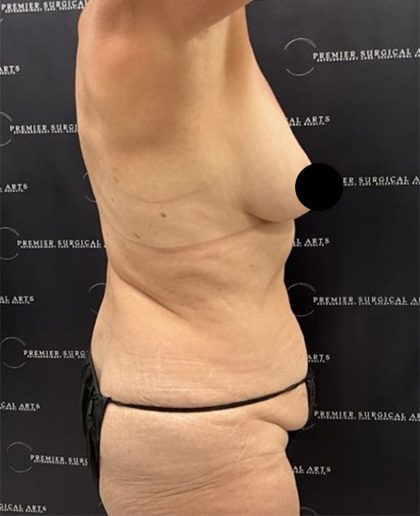 Liposuction Before & After Patient #2385
