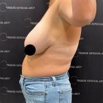 Liposuction Before & After Patient #2378