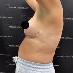 Liposuction Before & After Patient #2378