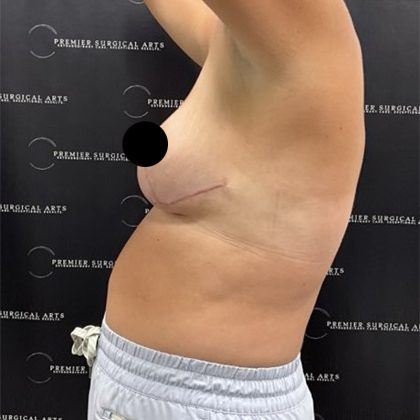 Liposuction Before & After Patient #2378