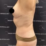 Liposuction Before & After Patient #2385