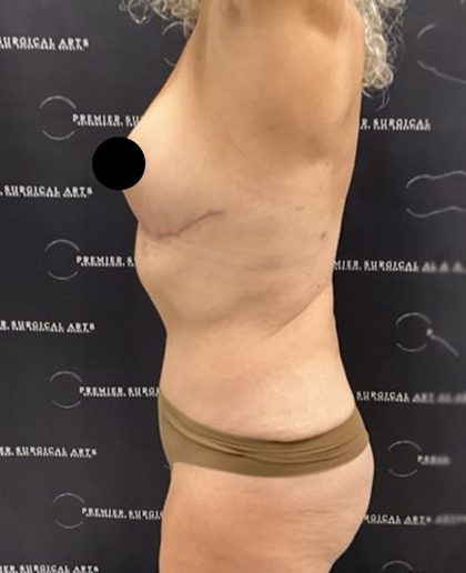 Liposuction Before & After Patient #2385