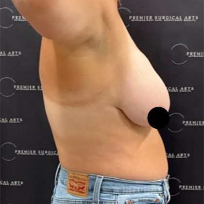 Liposuction Before & After Patient #2378