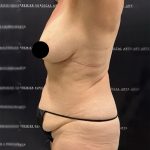 Liposuction Before & After Patient #2385