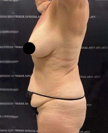 Liposuction Before & After Patient #2385