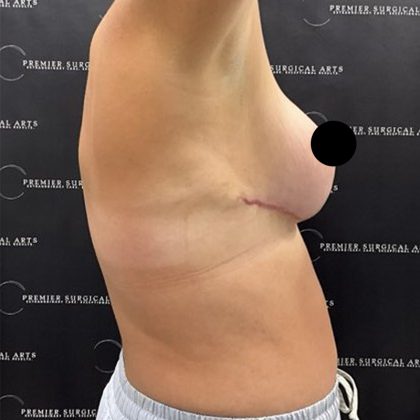 Liposuction Before & After Patient #2378