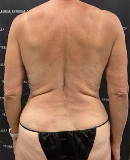 Liposuction Before & After Patient #2385