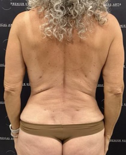 Liposuction Before & After Patient #2385