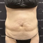 Tummy Tuck Before & After Patient #2447