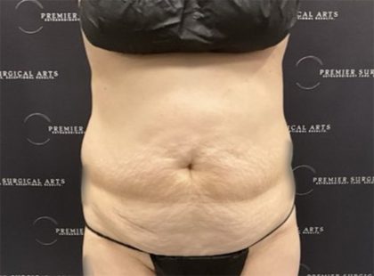Tummy Tuck Before & After Patient #2447