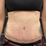 Tummy Tuck Before & After Patient #2447