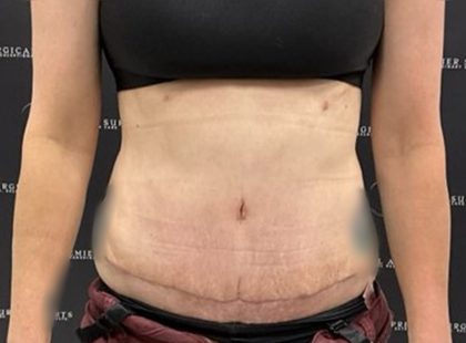 Tummy Tuck Before & After Patient #2447