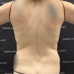 Tummy Tuck Before & After Patient #2447