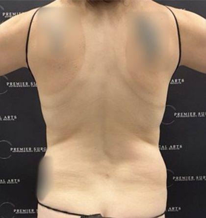 Tummy Tuck Before & After Patient #2447