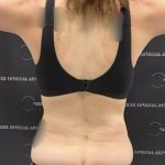 Tummy Tuck Before & After Patient #2447