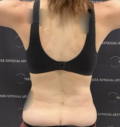 Tummy Tuck Before & After Patient #2447