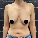 Breast Augmentation + Lift Before & After Patient #2442