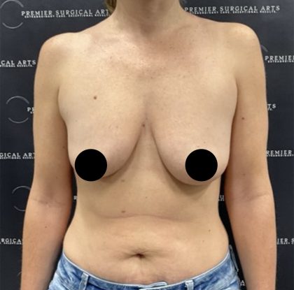 Breast Augmentation + Lift Before & After Patient #2442