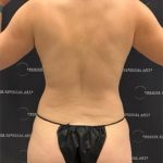 Tummy Tuck Before & After Patient #2438