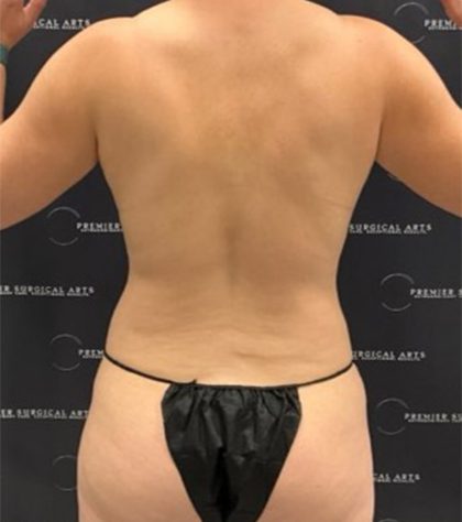 Tummy Tuck Before & After Patient #2438