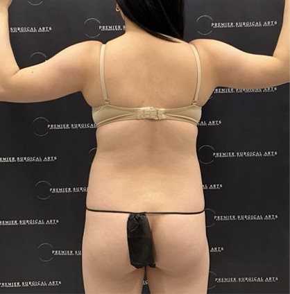 Renuvion Before & After Patient #2476
