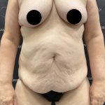 Liposuction Before & After Patient #2506