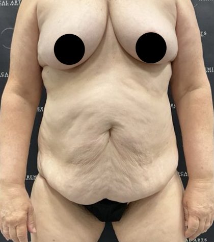 Liposuction Before & After Patient #2506