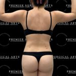 Renuvion Before & After Patient #2476