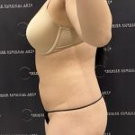 Renuvion Before & After Patient #2476