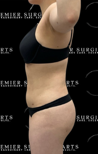 Renuvion Before & After Patient #2476