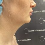Chin Liposuction Before & After Patient #2484