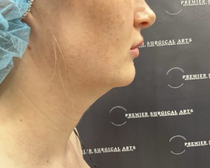 Chin Liposuction Before & After Patient #2484