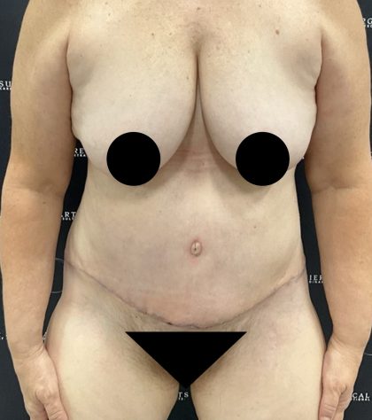 Liposuction Before & After Patient #2506