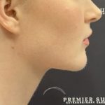 Chin Liposuction Before & After Patient #2484