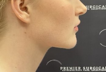 Chin Liposuction Before & After Patient #2484