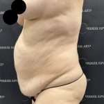Liposuction Before & After Patient #2506
